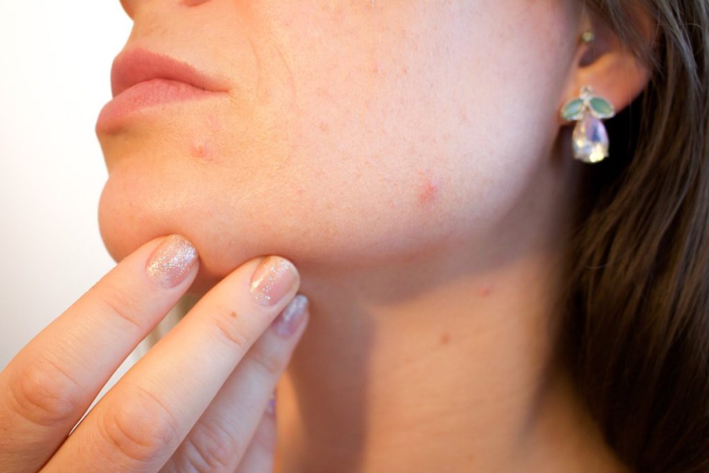 The quest to alleviate blackheads